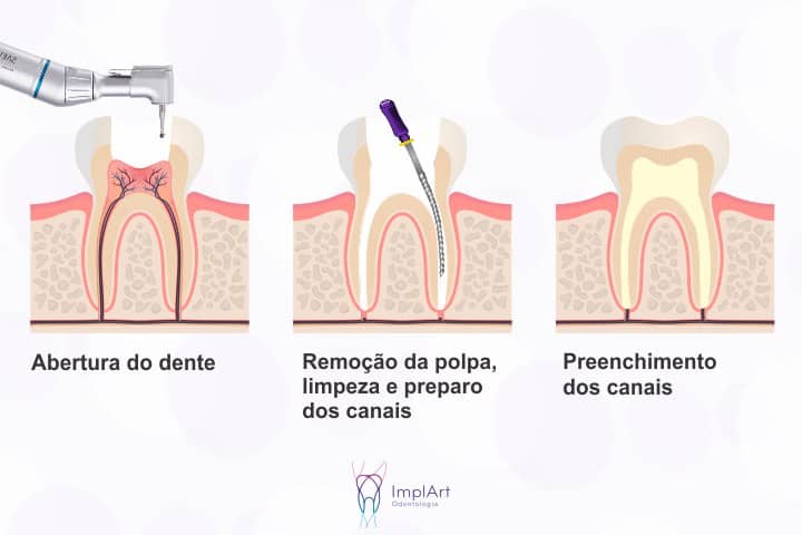 tratamento de canal