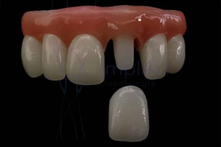 coroa zirconia individual 50kb