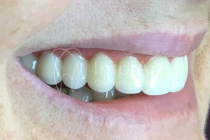 prótese dentária fixa