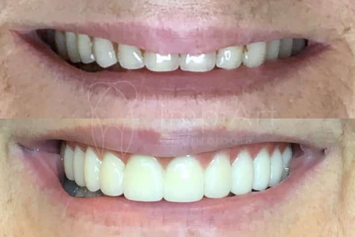 troca dentadura por protese fixa de zirconia