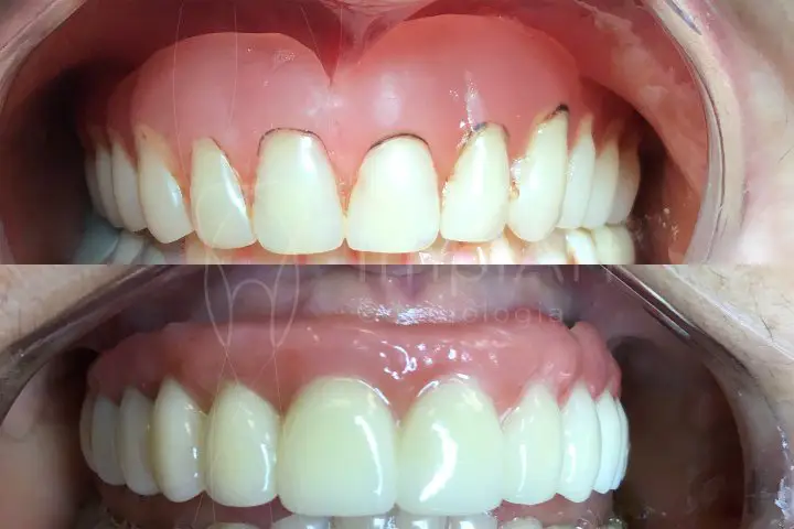 trocar substituir dentadura por dentadura fixa sobre implantes dentários