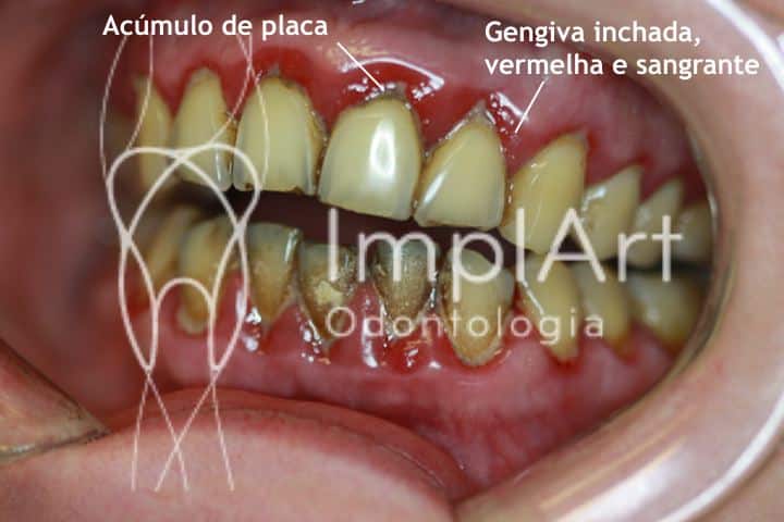 Gengivite avançada