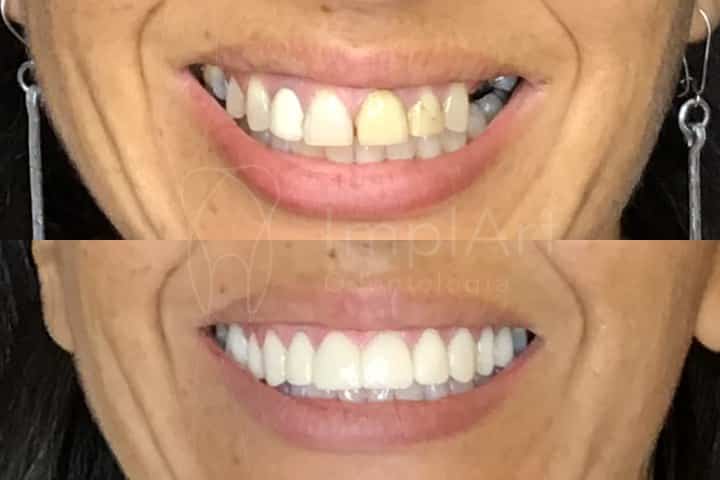 fotos de antes e depois de coroas sobre implantes dentarios lentes dentais