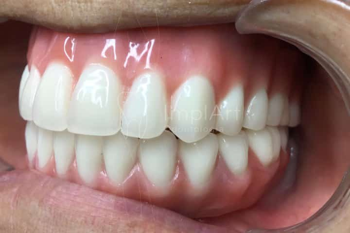 protese dentaria total fixa em resina sobre implantes