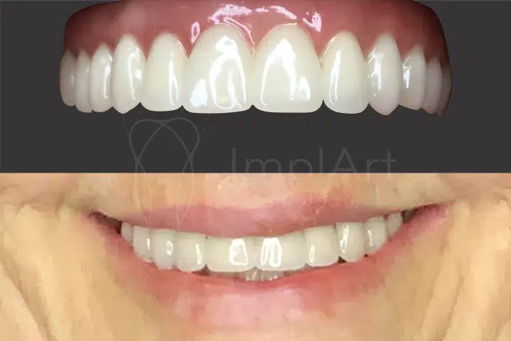 reabilitação oral prótese total fixa implantes dentários