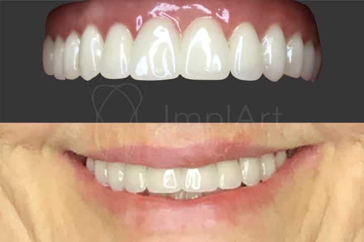 protese dentaria de zirconia total fixa implantes