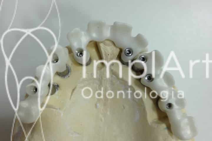 estrutura de prótese dentária fabricada em zircônia