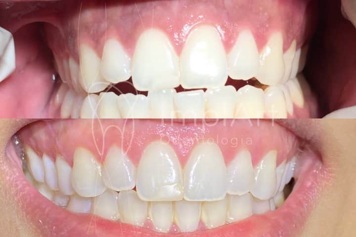 invisalign antes e depois