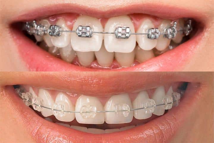 aparelho ortodontico convencional e estetico 50kb