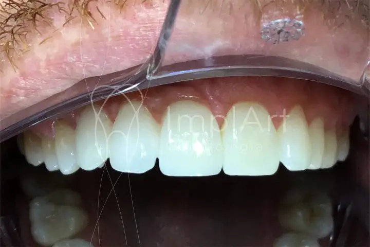 coroas de zirconia fixas em implante dentario