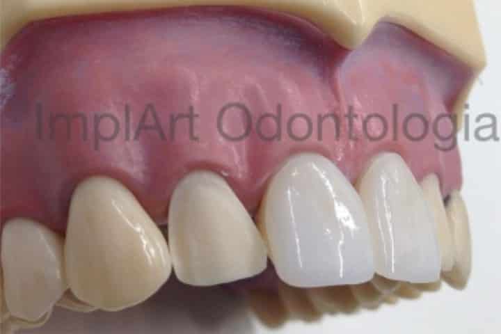 lente de contato dental 48kb