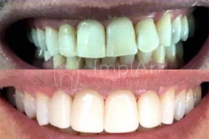 lente de contato dental antes e depois 49kb