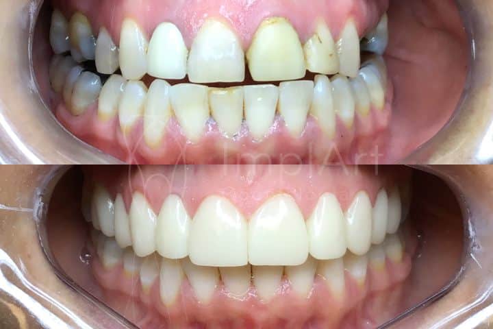 antes e depois de lente de contato dental