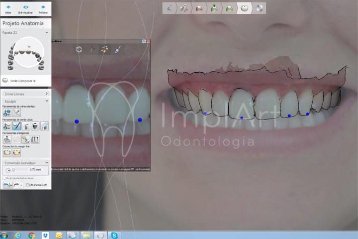 planejamento digital após escaneamento intraoral