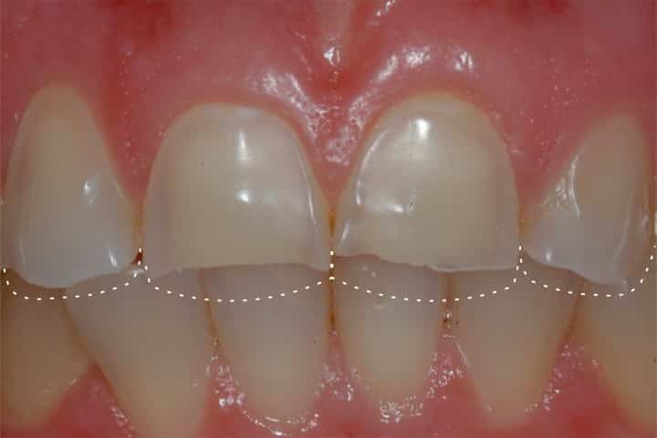 esmalte dentário desgastado e dentes curtos