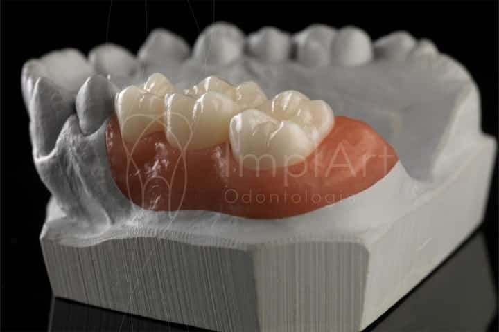 coroa zirconia pura multilayer translucida 50kb