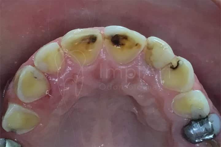 dentes com esmalte desgastado