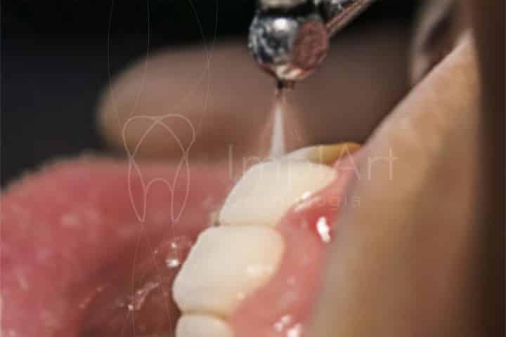 limpeza dos dentes profissional 3 50kb