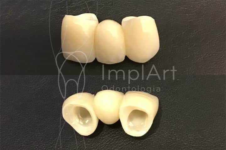 coroa de zirconia vista interna