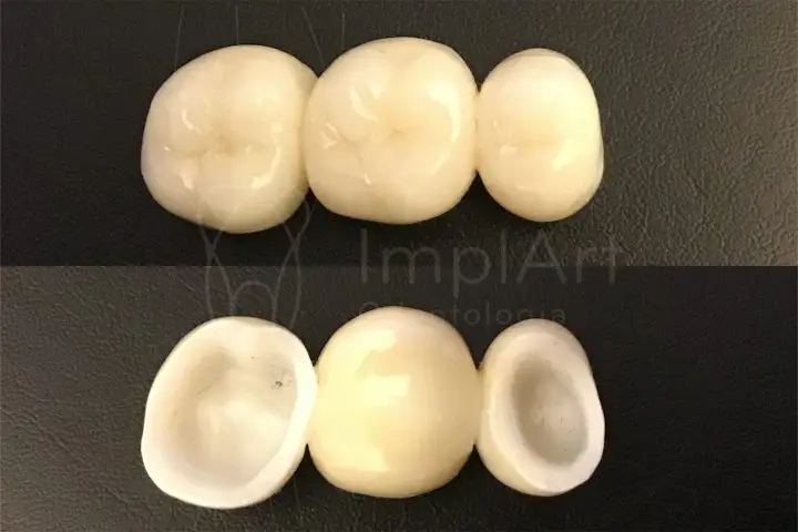 dentes de zirconia vista frontal e interna