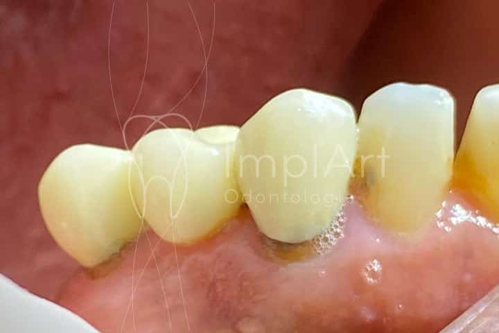 coroa metaloceramica com metal aparecendo por causa de perda óssea e retração gengival