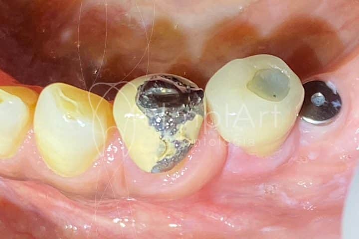 coroa de metaloceramica desgastada