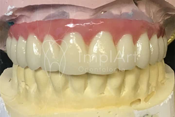 protese total de zirconia