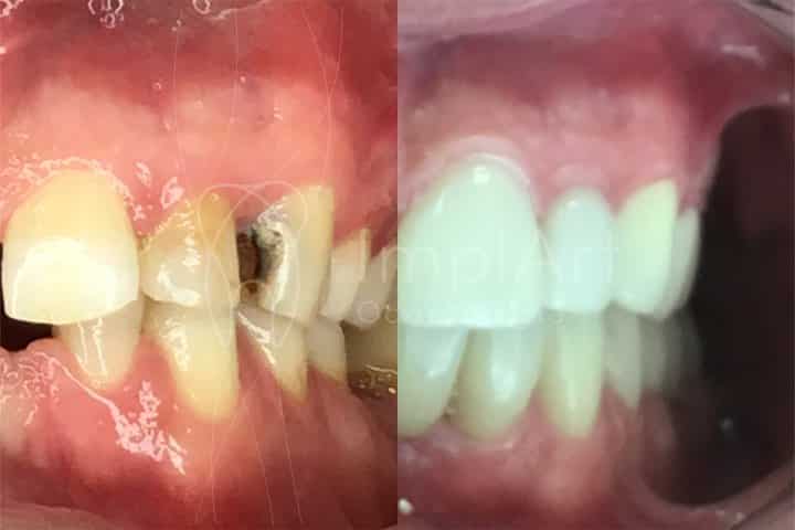 dente com cárie tratado restaurado antes e depois