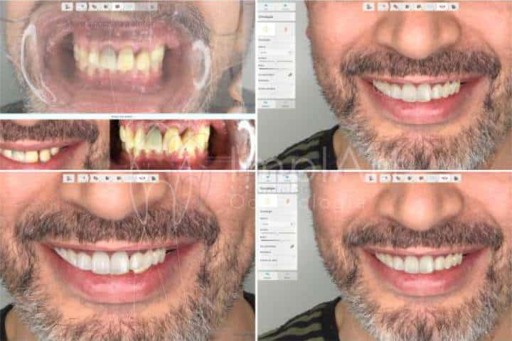 planejamento do sorriso digital tratamento computadorizado dentista