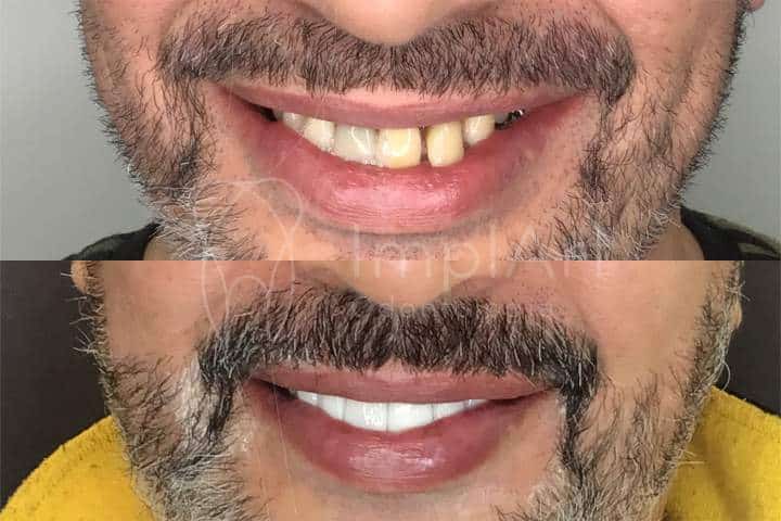 antes e depois de tratamento nos dentes