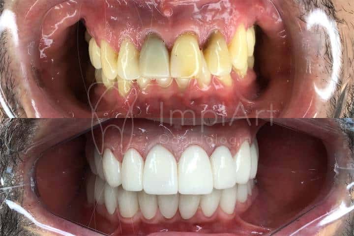 fotos antes e depois de tratamento nos dentes