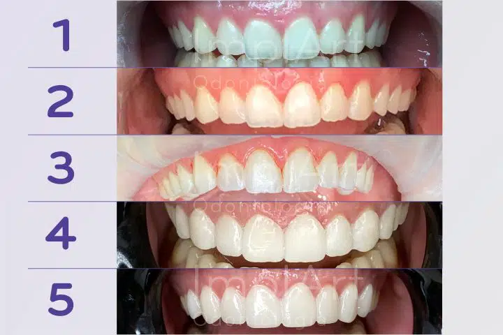 tratamento estetica dental lentes de contato dentais e gengivectomia