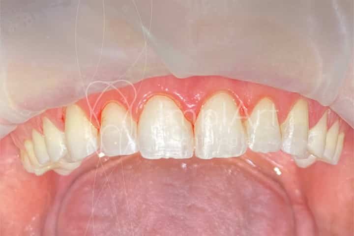 dentes desgastados para colocar lentes de contato dentais de porcelana