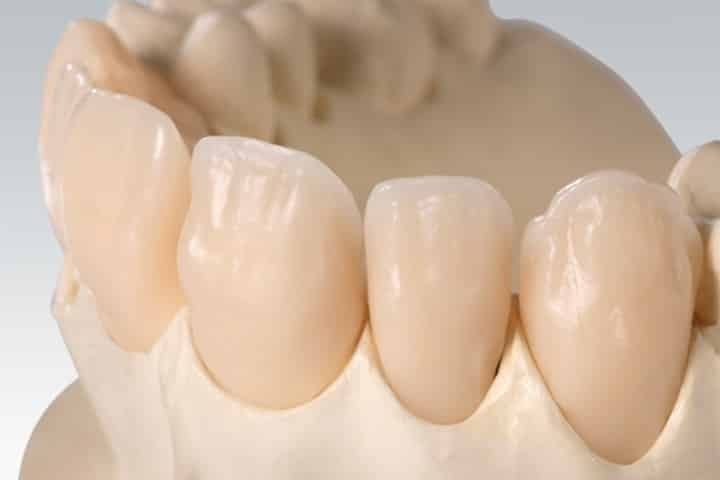 ceramil coroas zirconia 50kb