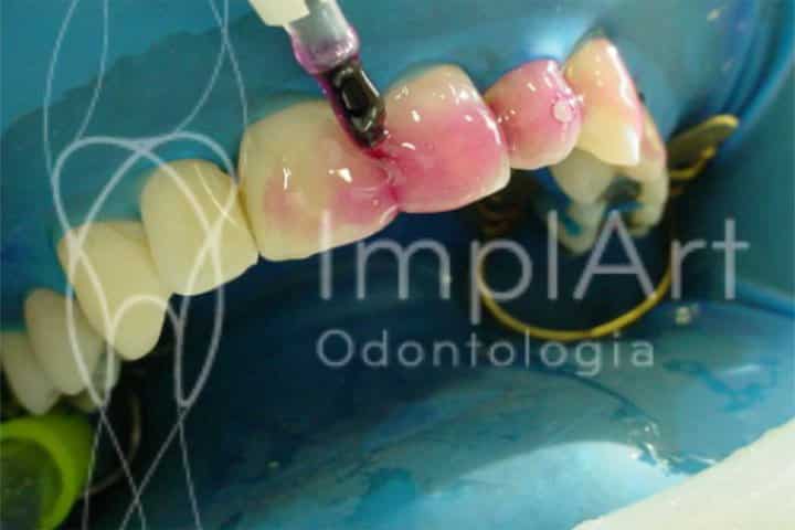 clareamento a laser dentes brancos