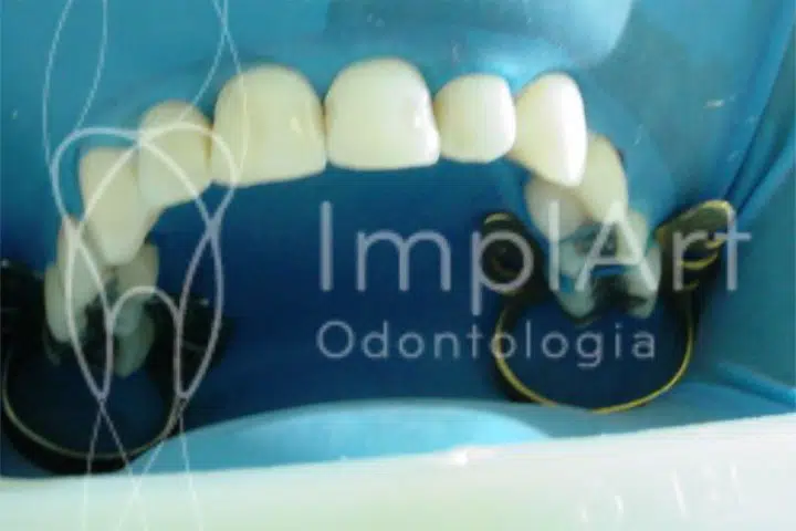 dentes brancos depois do clareamento a laser