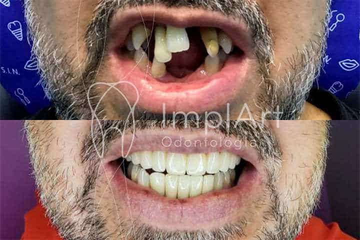 reabilitacao oral completa implantes dentarios