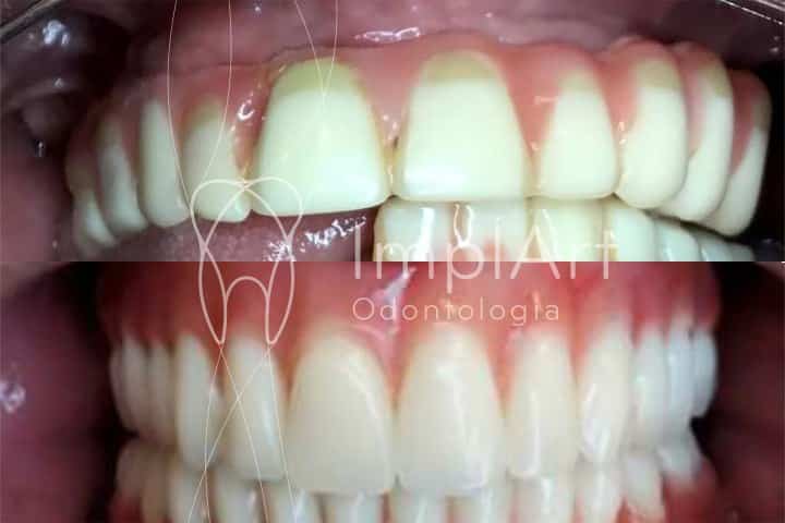 protese metaloplastica antes depois reabilitacao oral 50kb