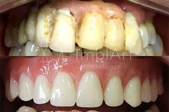 PRÓTESE PROTOCOLO SOBRE IMPLANTES