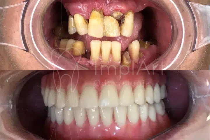 coroas dentarias fixas sobre implantes