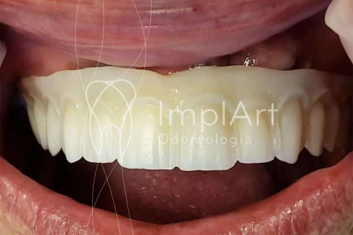 protese dentaria de zirconia estrutura interna