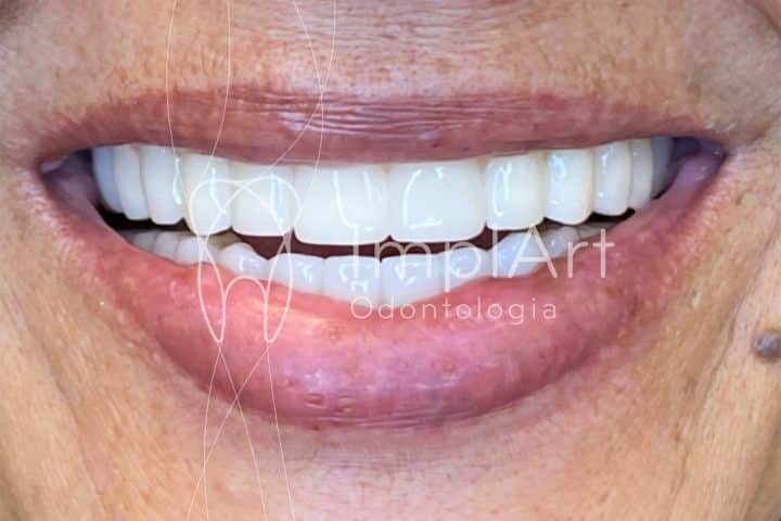 protese dentaria de zirconia estetica