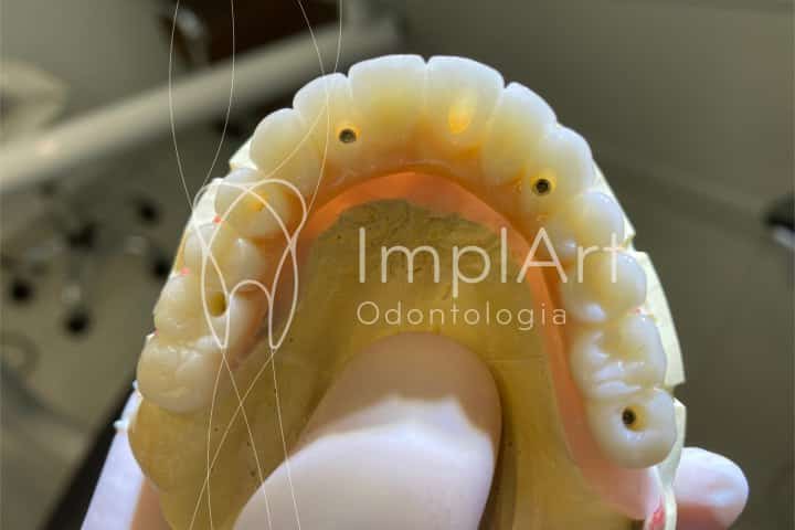protese dentaria fixa em implantes de zircnonia translucida