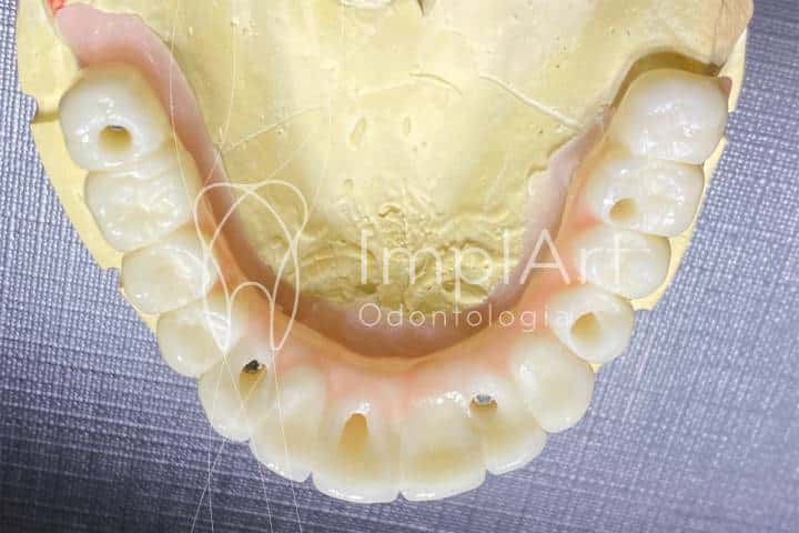 protese dentaria fixa sobre implantes zirconia