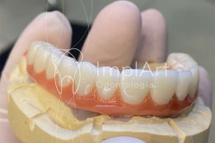 protese de zirconia fixa implantes dentarios