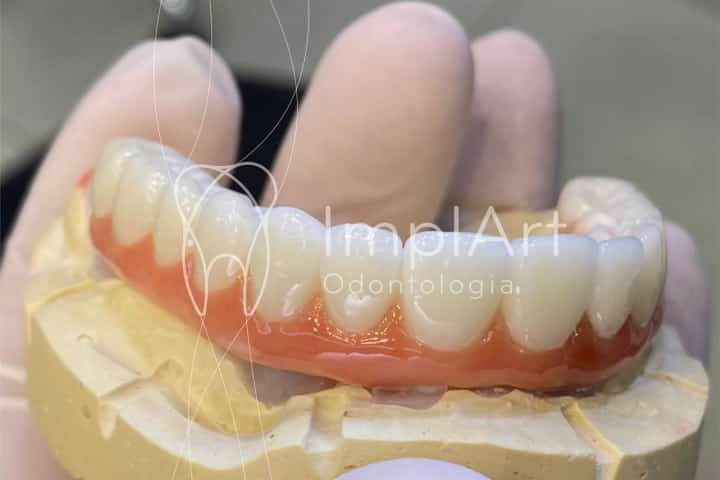 protese total zirconia superior para implantes 50kb