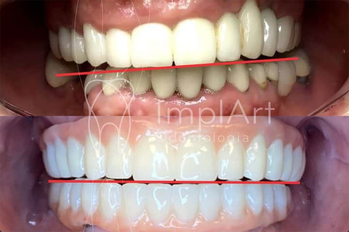 coroas metaloceramicas x protese de zirconia dental