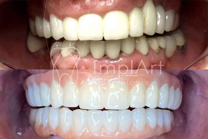 fotos de prótese dentária