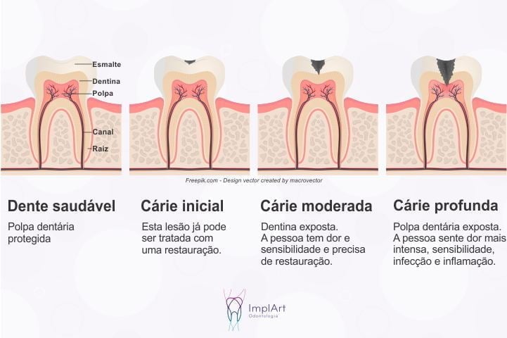 carie tratamento canal 50kb