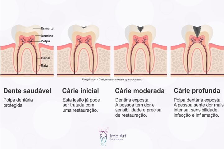 Dente Com Buraco De C rie O Que Fazer C ries Como Tratar Dente Com Buraco De C rie O Que Fazer C ries Como Tratar